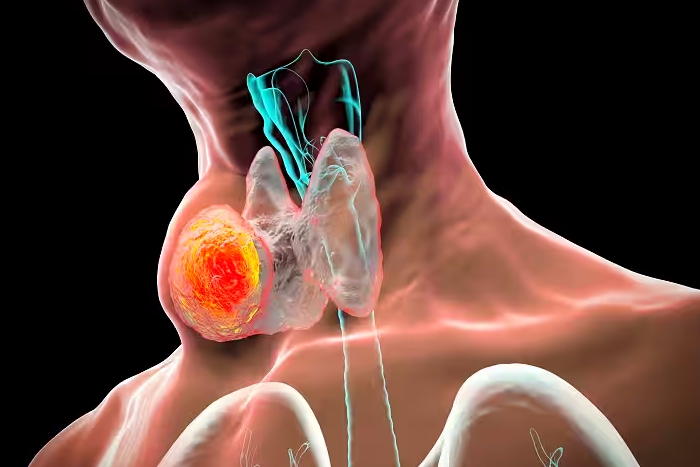 Thyroid cancer suregon in vizag