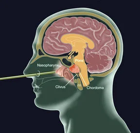 Skull Base Cancer Treatment
